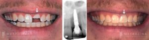 Dental Implants Before and After Patient 5a