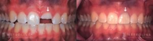 Dental Implants Before and After Patient 5b