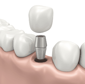 Replacement Tooth Shown Above Abutment As It Is Inserted Into Jaw Bone