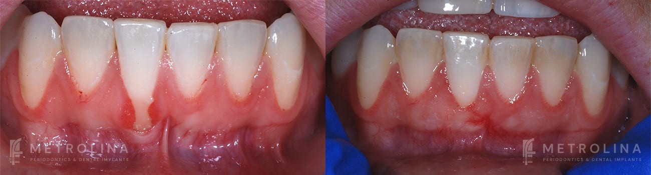 metrolina-periodontics-charlotte-connective-tissue-graft-patient-1-1-1