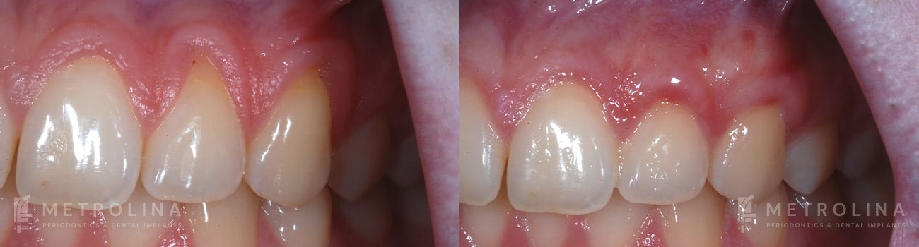 Connective Tissue Graft Before and After Patient 2.1.1