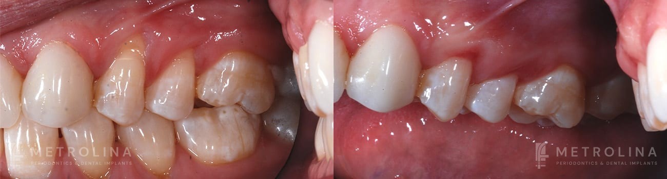 Connective Tissue Graft Before and After Patient 3.1.1
