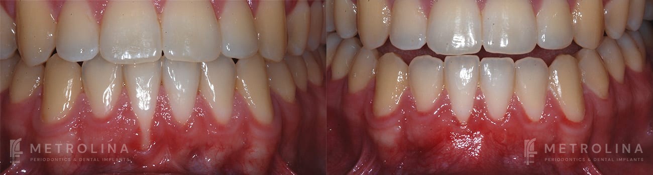 Connective Tissue Graft Before and After Patient 4.1.1
