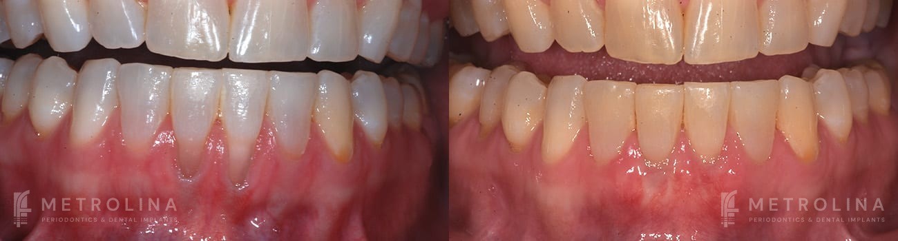 Connective Tissue Graft Before and After Patient 5.1