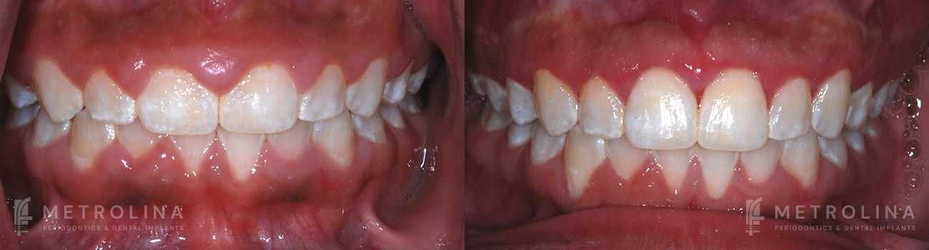Crown Lengthening Before and After Patient 1.1.1