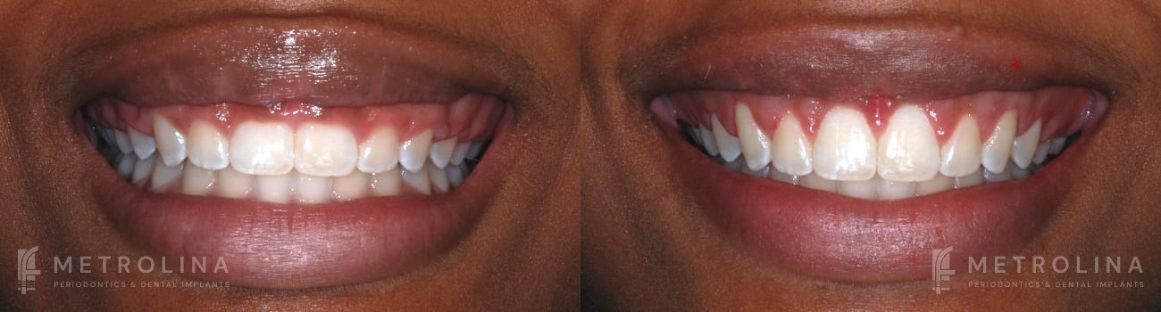 Crown Lengthening Before and After Patient 2.1.1