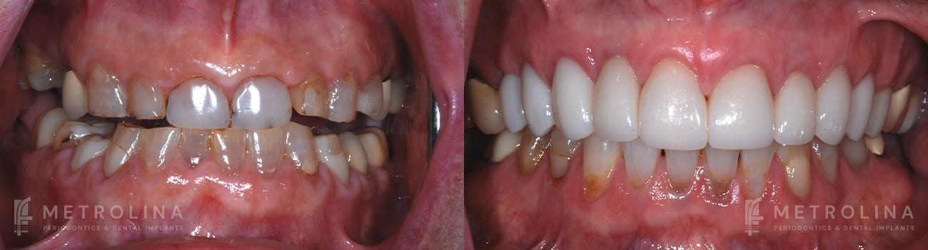 Crown Lengthening Before and After Patient 3.1.1.1