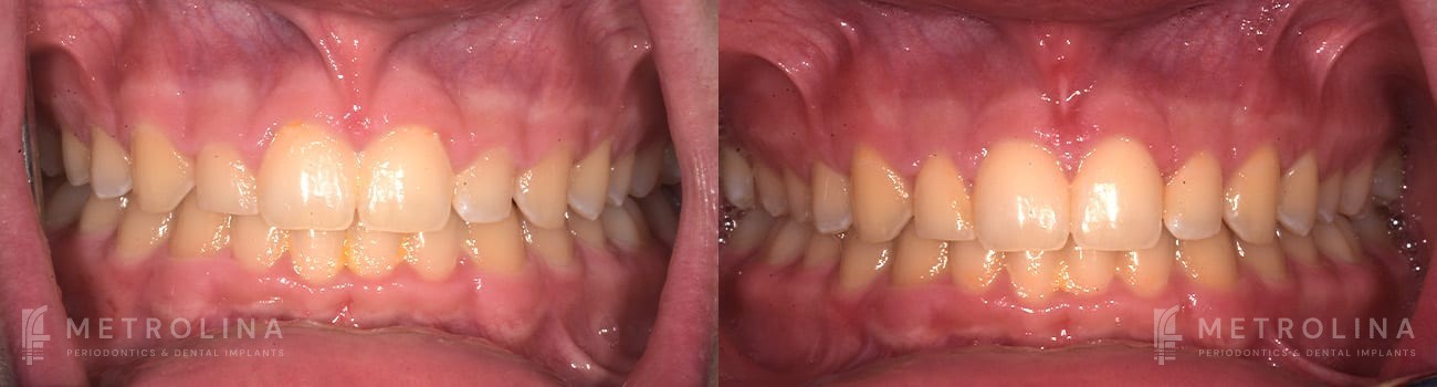 Crown Lengthening Before and After Patient 4.1