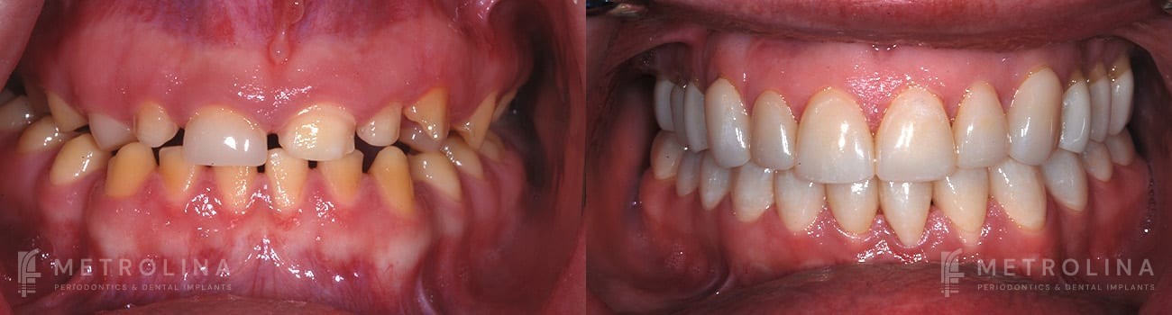 Crown Lengthening Before and After Patient 5.1