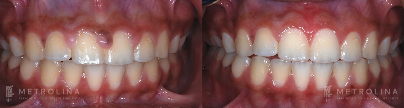 Gingivectomy Before and After Patient 1.1.1