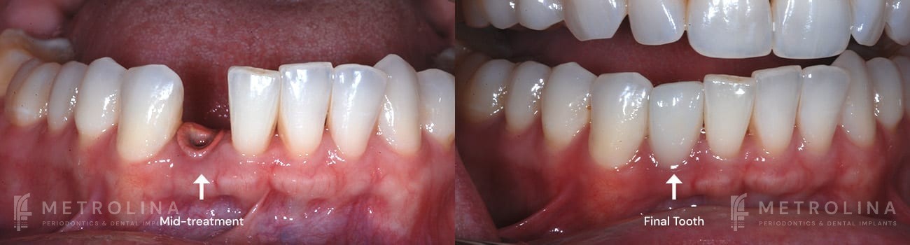 Dental Implants Before and After Patient 2.1