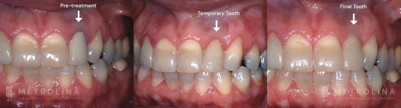 Dental Implants Before and After Patient 3.1