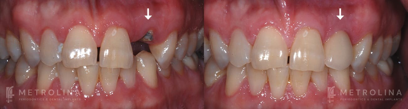Dental Implants Before and After Patient 4.1
