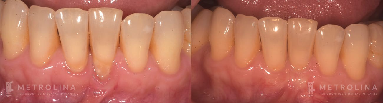 Connective Tissue Graft Before and After Patient 6.1