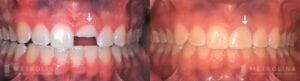 Dental Implants Before and After Patient 5.1